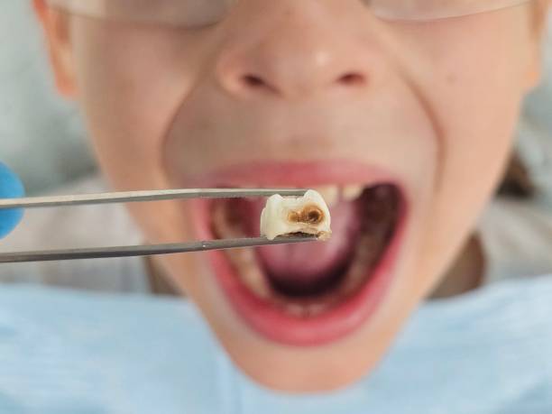 Best Broken or Cracked Tooth Emergency Dentist in Alamo, TN